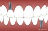 Zentrale Kostenfaktoren bei Zahnimplantaten